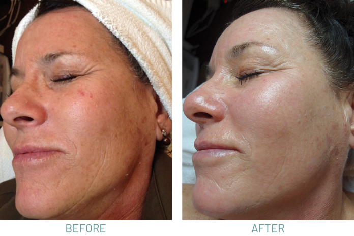Microdermabrasion vs. Chemical Peels: Which One Is Right for You?
