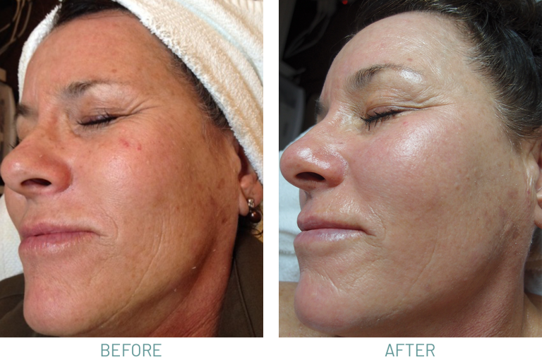 Microdermabrasion vs. Chemical Peels: Which One Is Right for You?