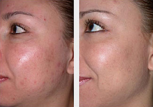 How Microdermabrasion Can Help Reduce Fine Lines and Wrinkles