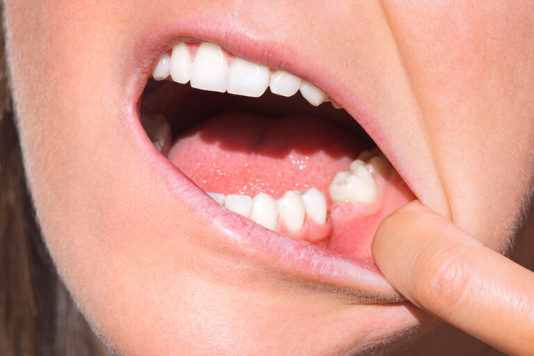 Understanding the Mystery: Exploring the Causes of Hole in Gums
