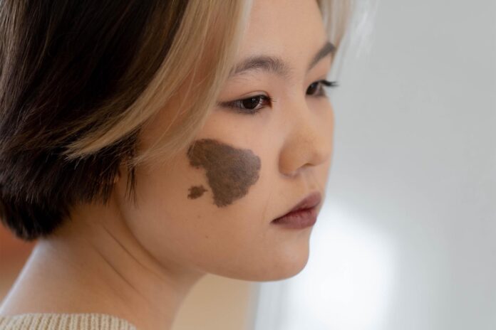 birthmark removal