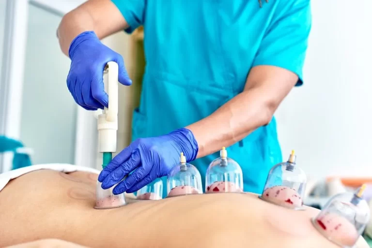 Hijama Therapy for Body and Mind Cleansing