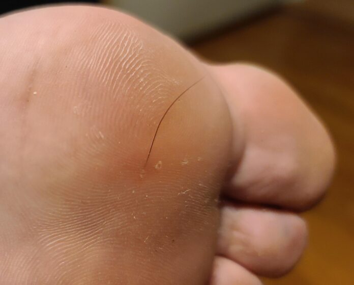 hair splinter