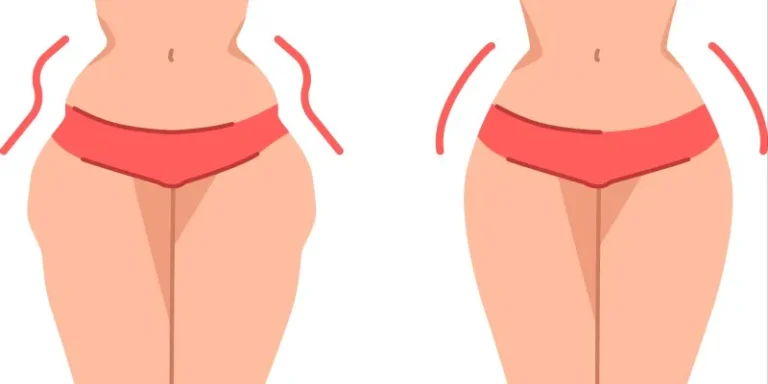 Hip Dips: Why Do I Have Them, and Can I Minimize Them?
