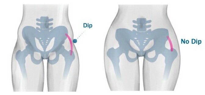 hip dips 1